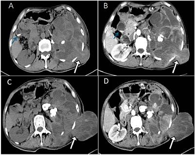 Huge intermediate-grade myofibroblastic sarcoma in the retroperitoneum revealed by 18F-FDG PET/CT: a case report